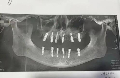 一次性拔牙23颗种12颗 13天后去世 实在太悲剧